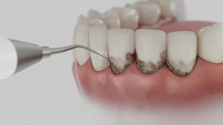 Trusted Tooth Extraction service in Lebanon, IN - Dentist Open Now
